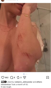 Nina Seničar ogrebotina