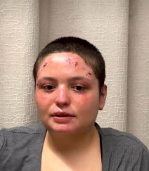 Preživela žrtva požara u Švajcarskoj (2).jpg