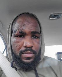 MMA zvezda Kori Anderson jezive povrede stalo srce foto galerija UFC najnovije vesti