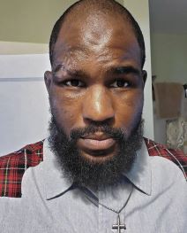 MMA zvezda Kori Anderson jezive povrede stalo srce foto galerija UFC najnovije vesti