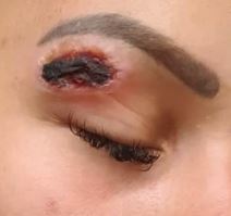 plazma pen iskustva tretman lica posledice