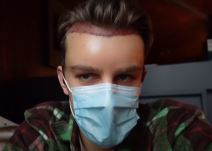 andrija jo operacija presadjivanje kose turska foto