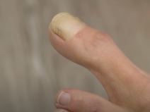 stopala izgled dug palac neobicni zdravstveni problemi