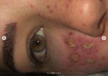 kucni tretmani za kozu posledice fotografije 