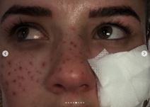 kucni tretmani za kozu posledice fotografije 