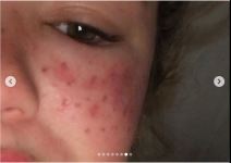 tretman za uklanjanje akni tiktok akupunktura unakazila lice drustvene mreze