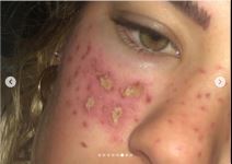 tretman za uklanjanje akni tiktok akupunktura unakazila lice drustvene mreze