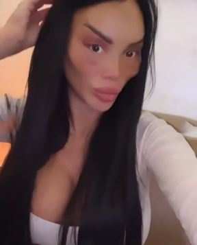 posle plastičnih operacija (5).jpg