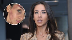 Ivana Dudić u modricama