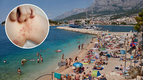 impetigo