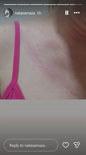 Nataša Maza povrede (3).jpg