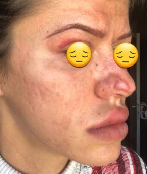 dr colic laser plazma pen kozmeticki saloni