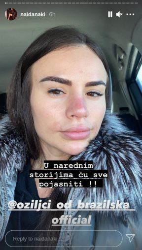 naida gadzo plasticne operacije silikoni slike 