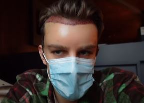 andrija jo operacija presadjivanje kose turska foto