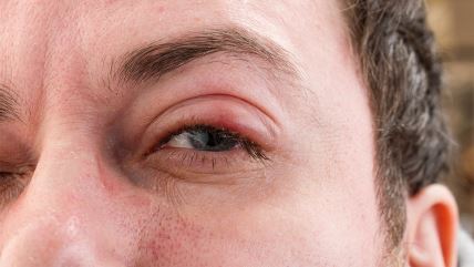 Oko i otečeni gornji kapak zbog trahoma, zarazne bolesti oka