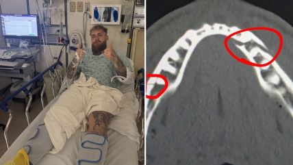 Entoni Džošua slomio vilicu Džejku Polu