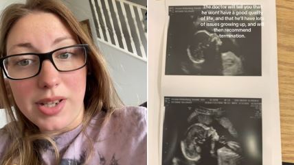 Kako izgleda i živi dečak koji je rođen sa crevima van stomaka.jpg