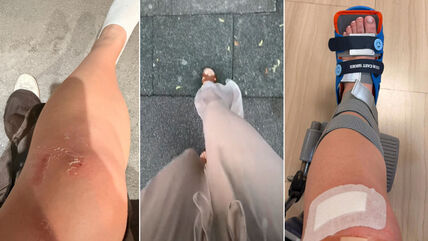 Povređene noge zbog Zarinih pantalona