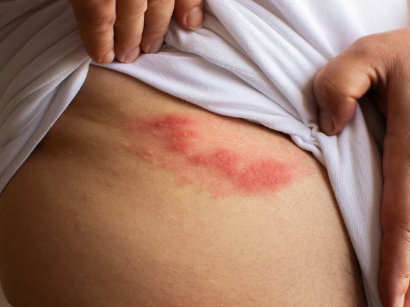 herpes zoster.jpg