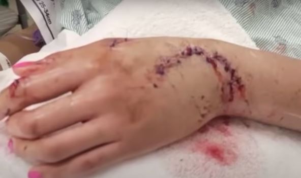 Ajkula ugrizla devojku za ruku.