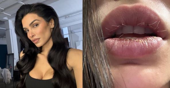 Jovana Đorđević vadila biopolimer iz usana