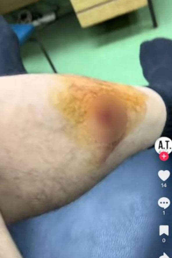 Slika rane na nozi Andrije Terzića od pucnjave