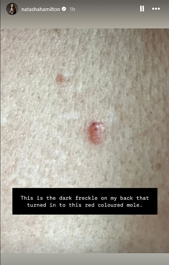 tumor na leđima Nataša Hamilton