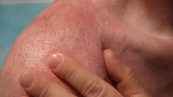 Rame, crvenilo, koža, ruka