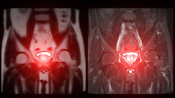 Magnetna rezonanca prostate, koja otkriva uvećanu veličinu i pomaže u dijagnostikovanju tumora.