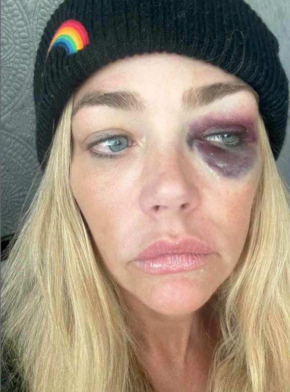 Deniz Ričards pretučena