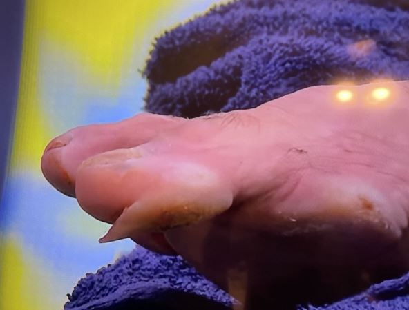 Novak Đoković žulj na US Openu