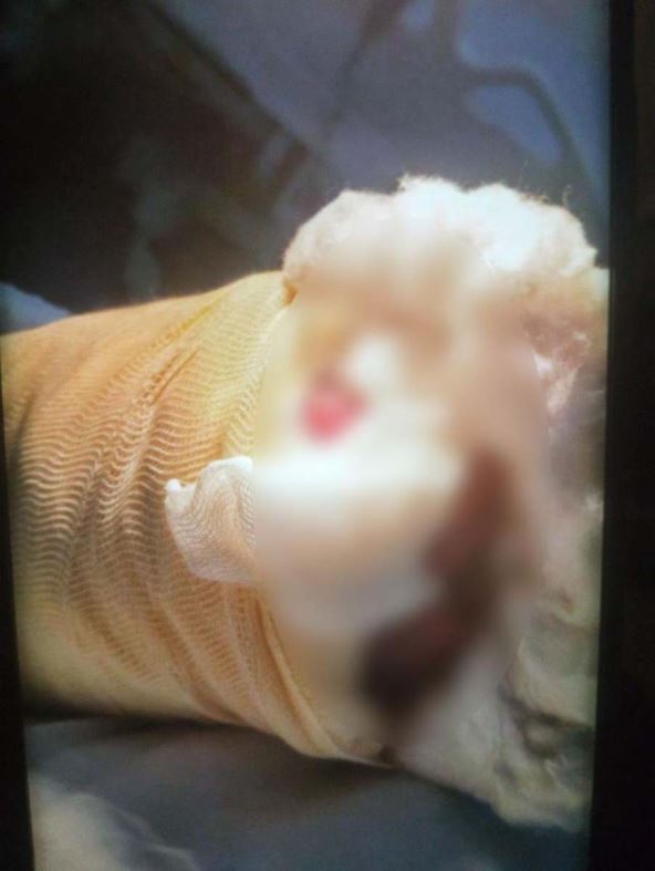 Dečak operacija šake 1.jpg