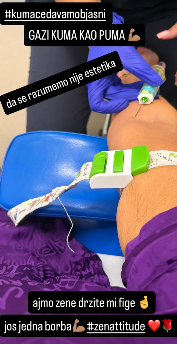 Milena naglasila da se ne operiše zbog estetike