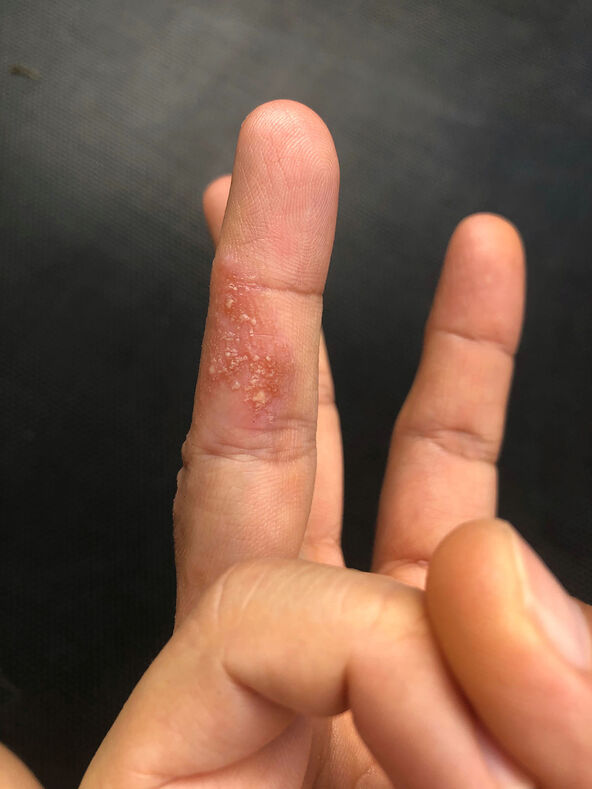 Kontaktni dermatritis na prstu