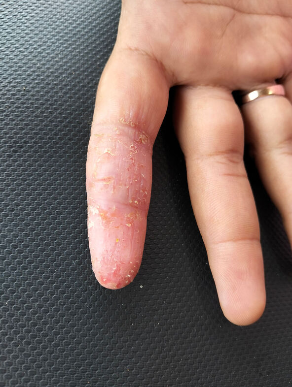 Kontaktni dermatritis na prstu