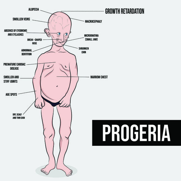 Progerija simptomi