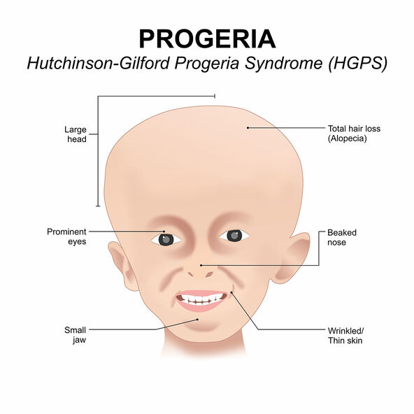 Progerija