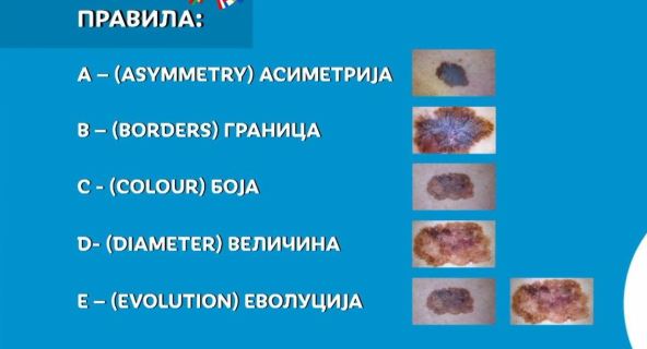 solarijum rak koze kako prepoznati rizican mladez melanom 