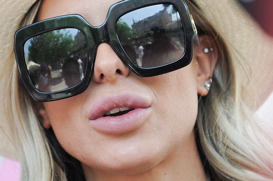 Zorannah usne blogerka povredila usnu