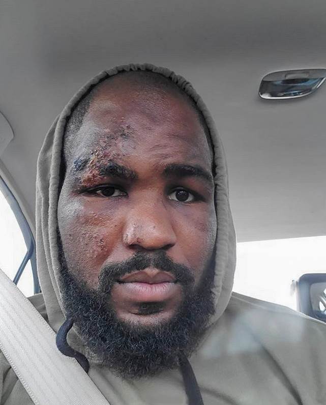 MMA zvezda Kori Anderson jezive povrede stalo srce foto galerija UFC najnovije vesti