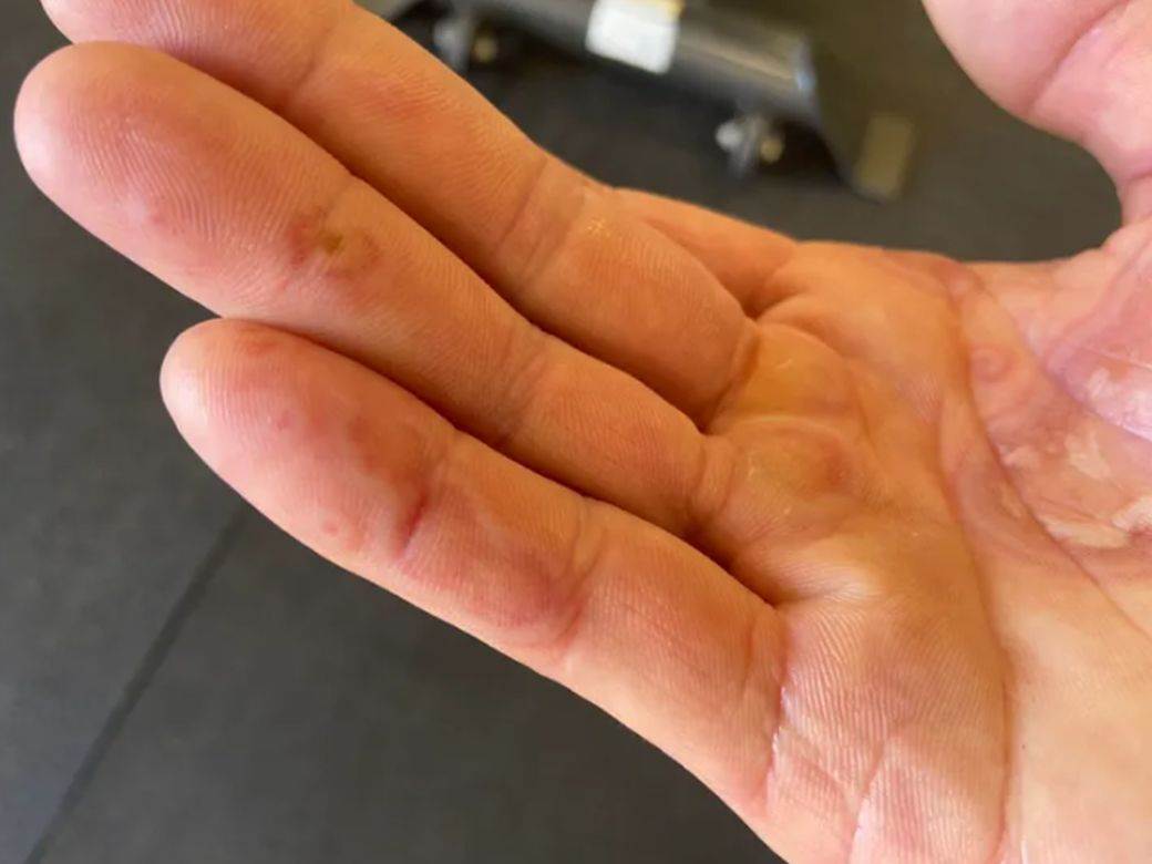 korona virus promene na kozi ispovest obolelog simptomi kovid prsti 