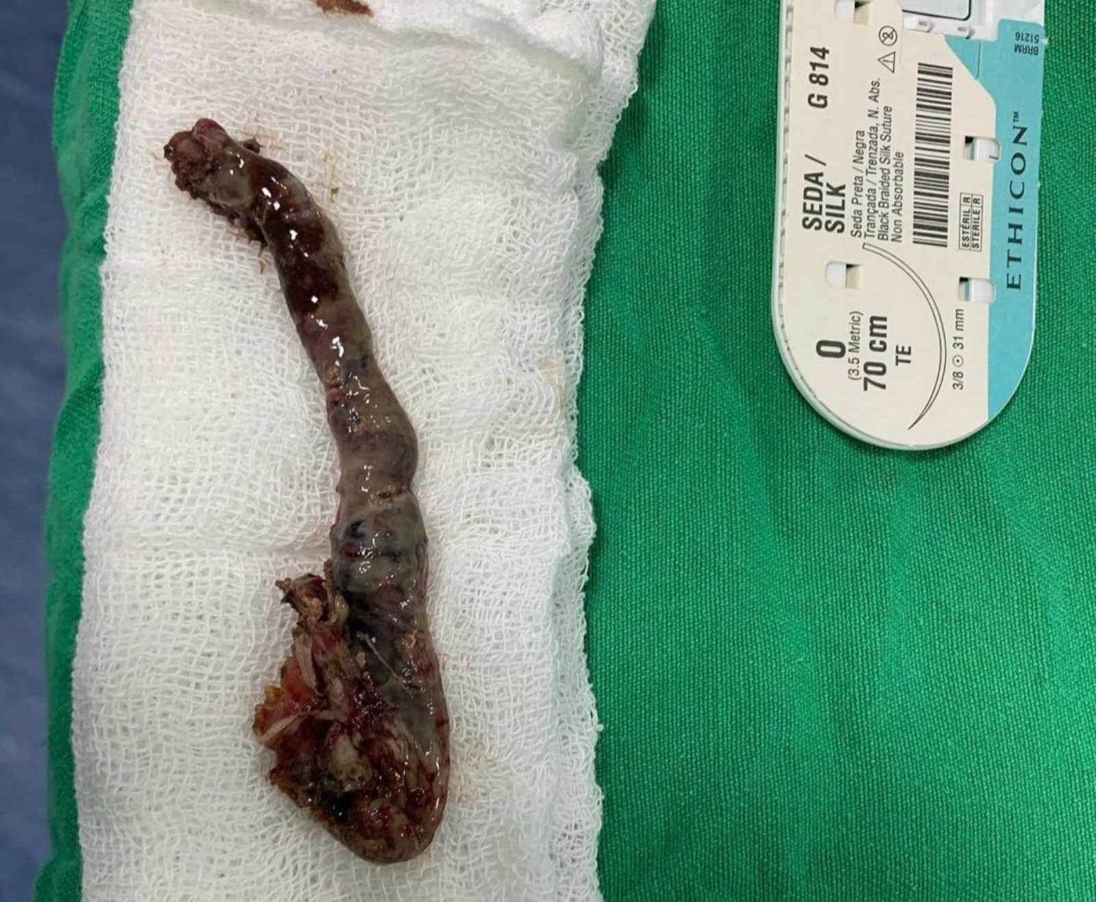 bet koreja mma fotografije operacija slepo crevo bolnica odseceni organ