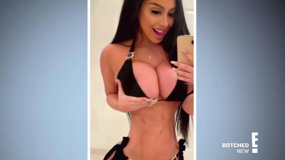 Devojka potrošila milion dolara na operacije 