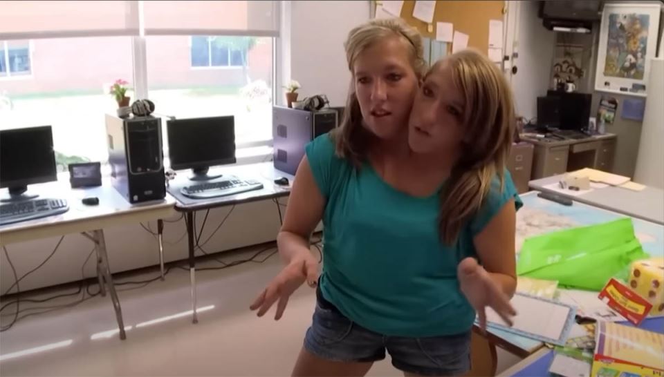 sijamske bliznakinje Ebi i Britani Hensel (2).jpg