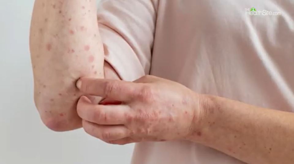 Simptomi lepre na šakama i rukama