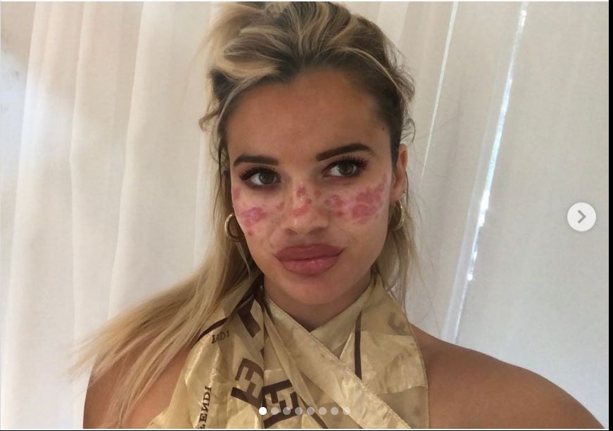 tretman za uklanjanje akni tiktok akupunktura unakazila lice drustvene mreze