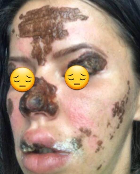 plazma pen iskustva tretman lica posledice