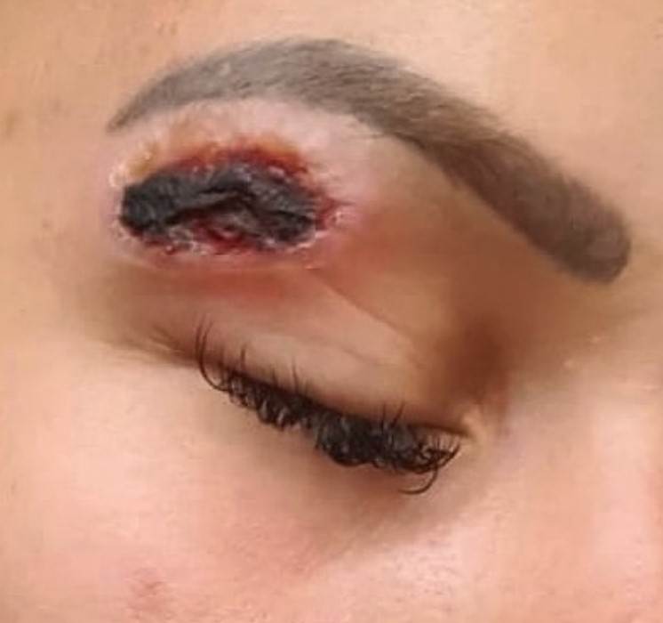 plazma pen iskustva tretman lica posledice