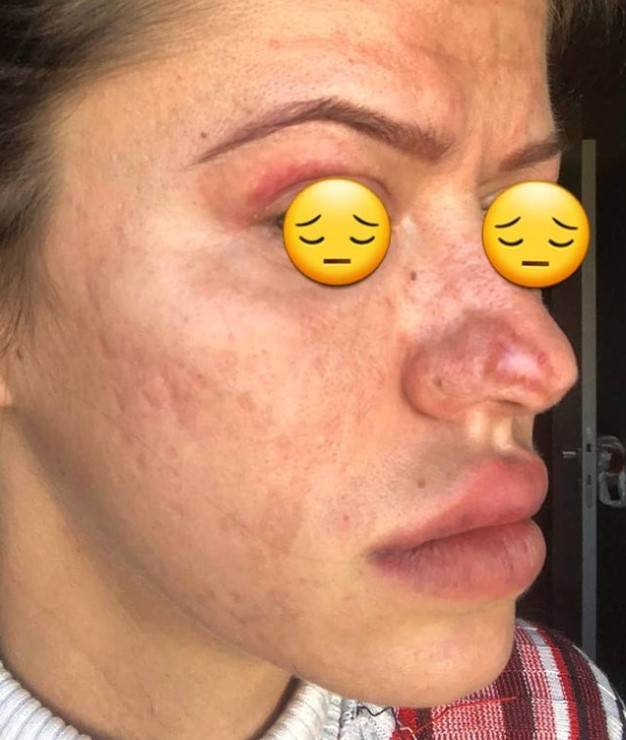 plazma pen iskustva tretman lica posledice