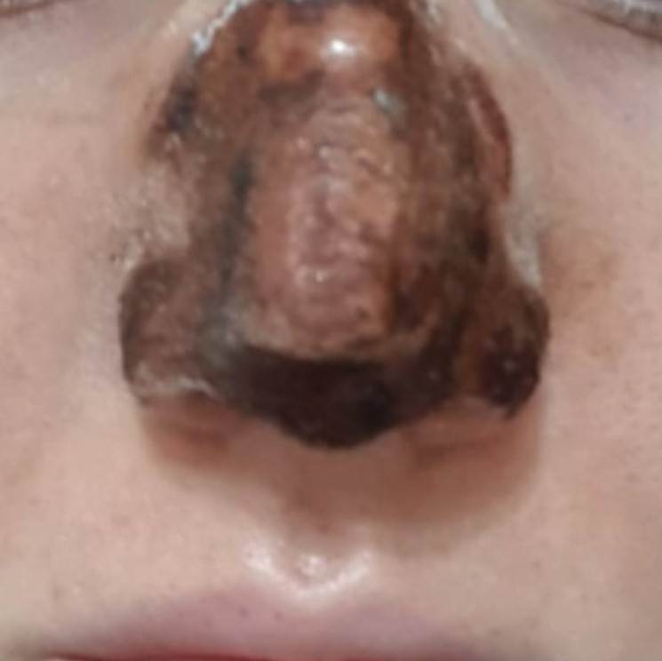 plazma pen iskustva tretman lica posledice